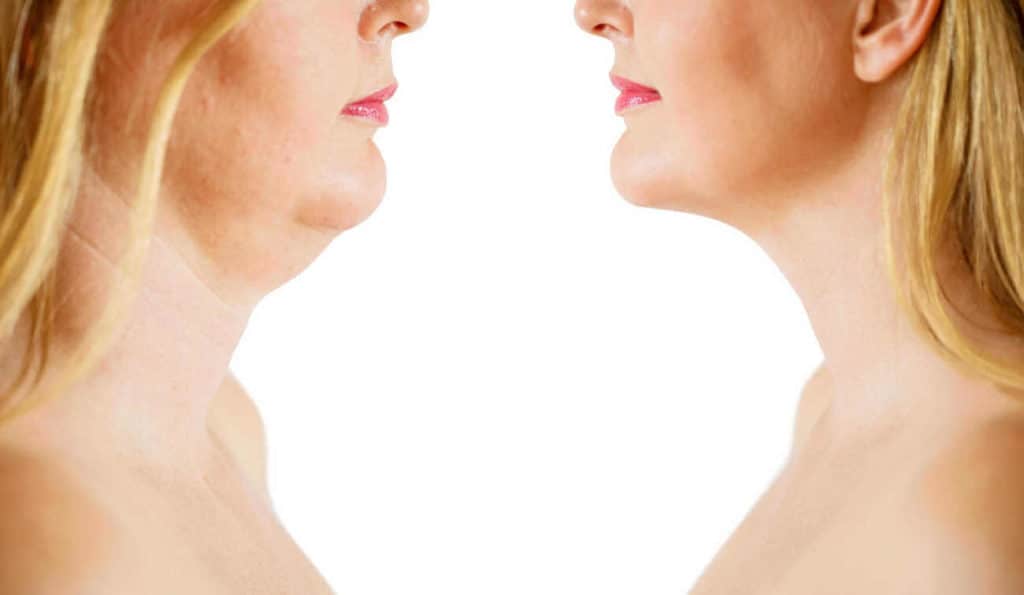 Double Chin treatment West Mersea before and after results
