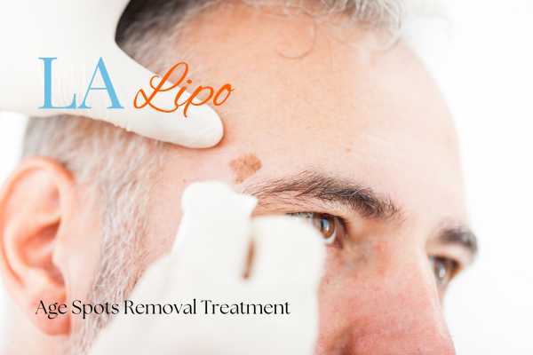 What Are the Most Effective Treatments for Age Spots West Mersea?