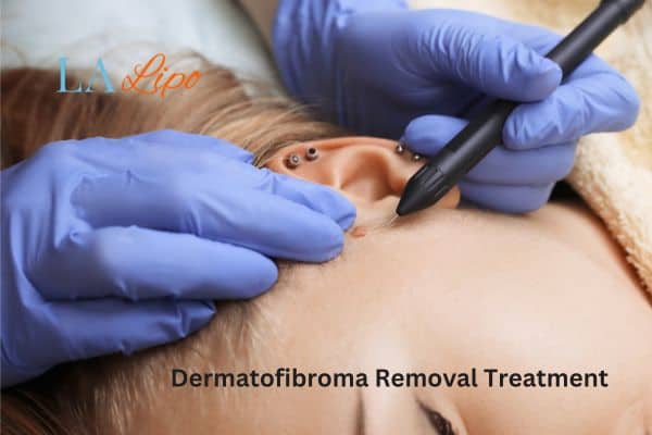 Dermatofibroma Removal Treatment West Mersea