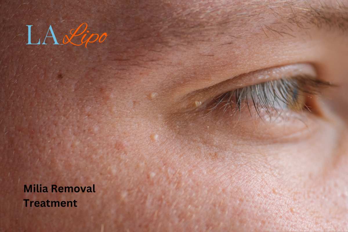 Cryopen Milia Removal: Is It the Easiest and Safest Option West Mersea?