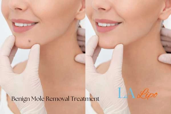 woman's before and after mole removal West Mersea results