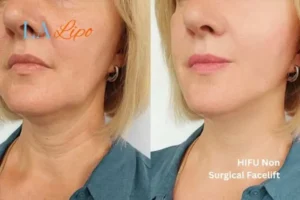hi-fu for wrinkles West Mersea before and after results