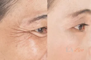 Before and after results of woman - HI-fu wrinkles reduction treatment West Mersea