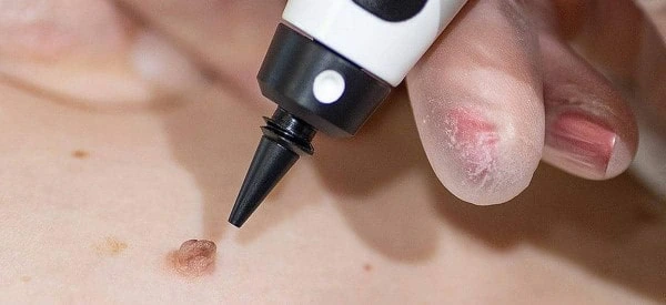 skin tag removal using cryopen West Mersea