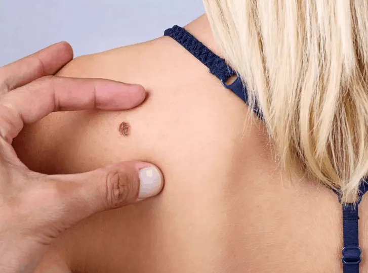 woman having mole removal West Mersea consultation before treatment.