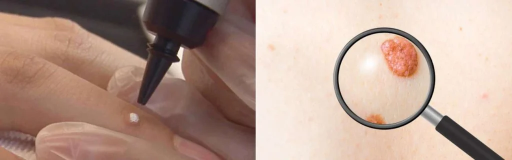 CryoPen practitioner West Mersea assessing a benign mole before treatment