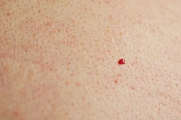 close up of a cherry angioma West Mersea