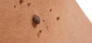 image of a skin tag West Mersea