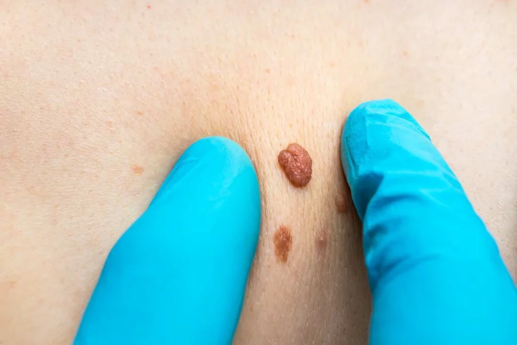 Consultant examining a skin tag West Mersea