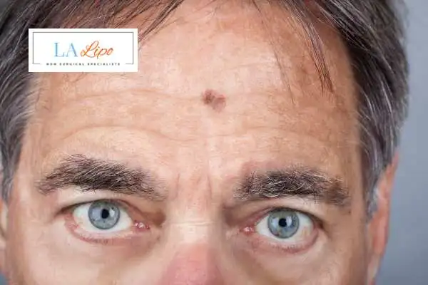 Solar Lentigo Removal West Mersea image of man with mark on his forehead