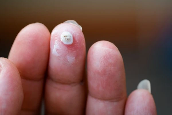 wart on person finger - cryotherapy to treat from LA LIPO West Mersea