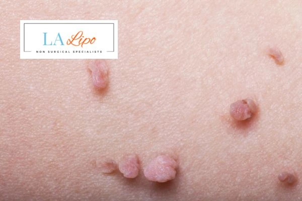 Does cryopen skin tag removal West Mersea hurt? Find out now call our team today!