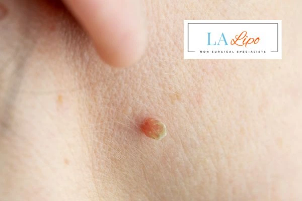 Book skin tag removal West Mersea today speak to our team now!
