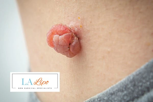 Interested in skin tag removal West Mersea? Concerned about the pain? Find out more today!