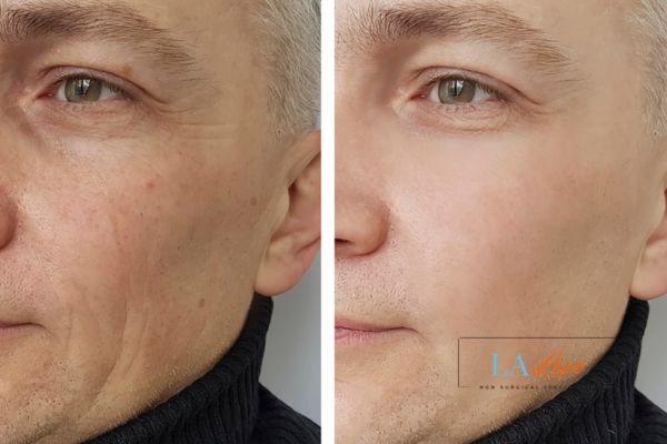See the amazing results of Morpheus8 Treatment West Mersea!