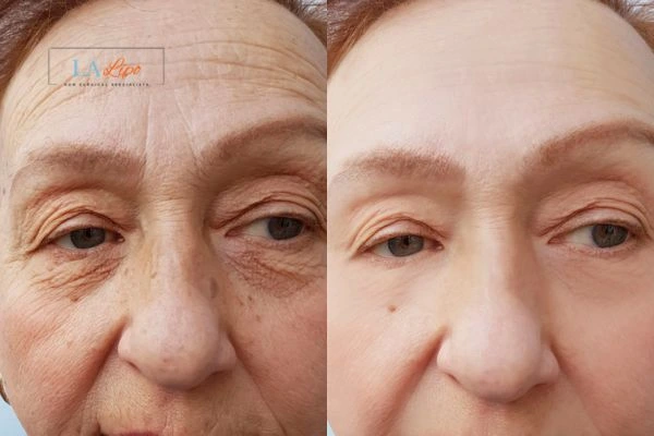 The powerful benefits of Morpheus8 Treatment West Mersea - Call Our team today!