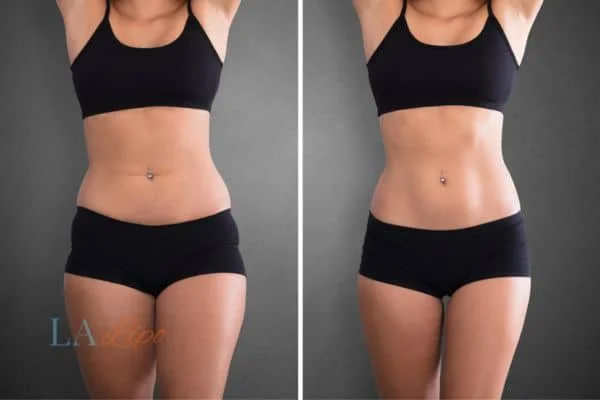 before and after results of non-surgical treatment to help a woman's body image and mental health West Mersea