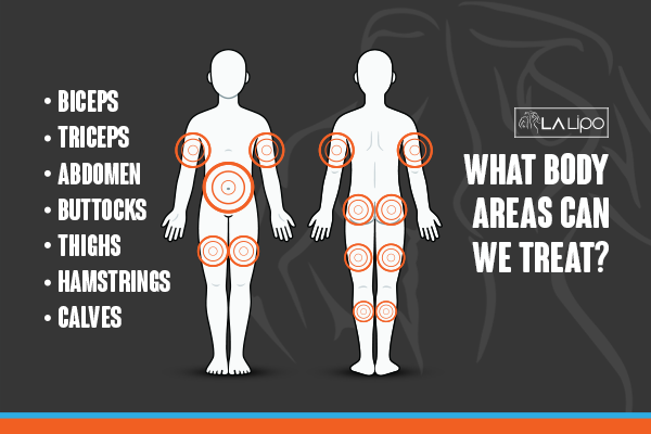 Diagram to show areas you can have LA-EMS Body Sculpting Treatment West Mersea
