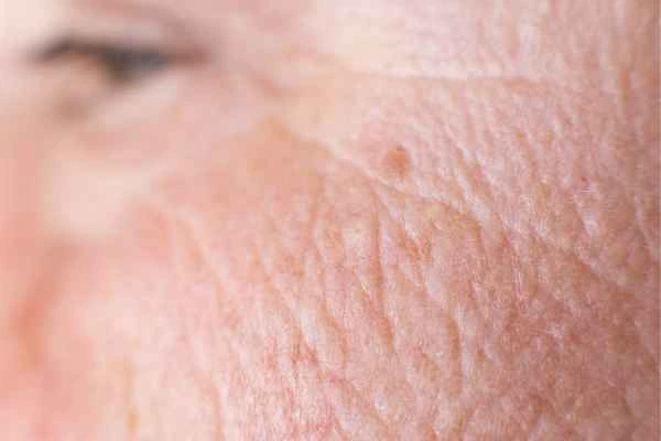 close up picture of a woman's face showing an age spot West Mersea