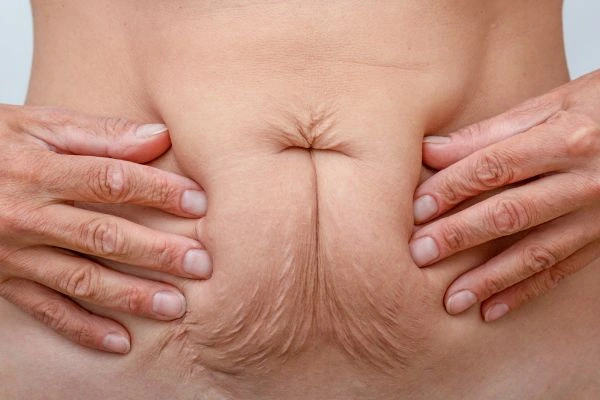 Image of a woman's stomach with loose skin - example of skin tightening West Mersea options