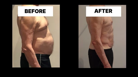 What Symptoms Can Diastasis Recti Cause in Men? Weak Core, Back Pain and Poor Posture West Mersea